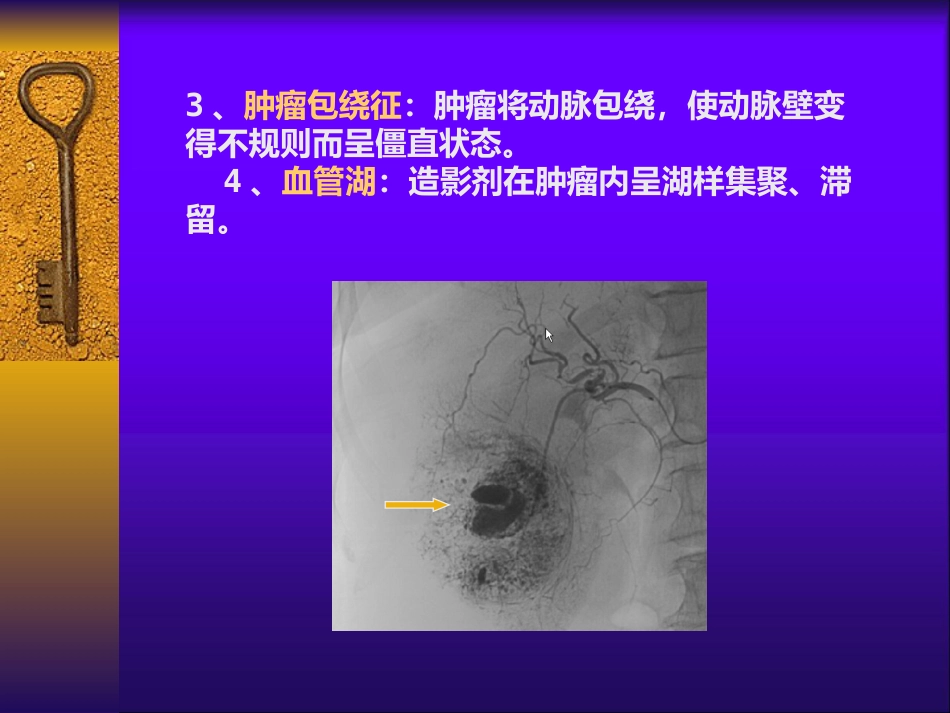 肝癌自发性破裂出血介入诊疗_第12页