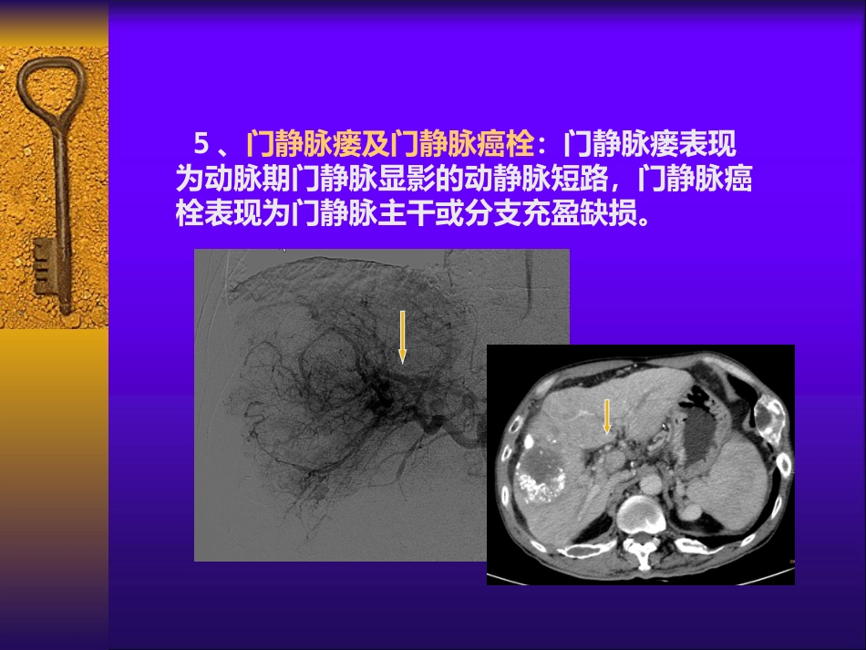 肝癌自发性破裂出血介入诊疗_第13页