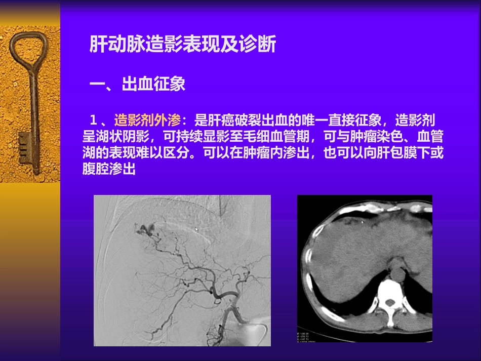 肝癌自发性破裂出血介入诊疗_第9页