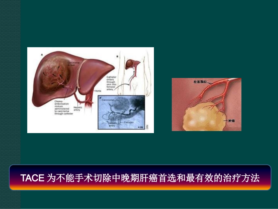 肝癌综合介入治疗进展ppt课件_第10页
