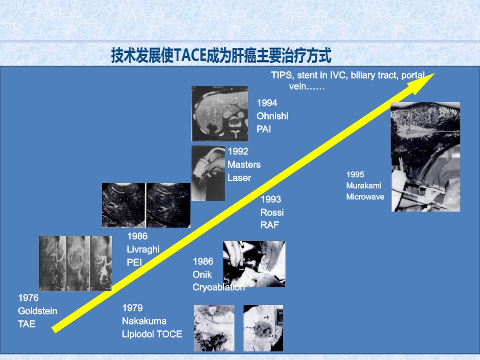 肝癌综合介入治疗进展_第4页
