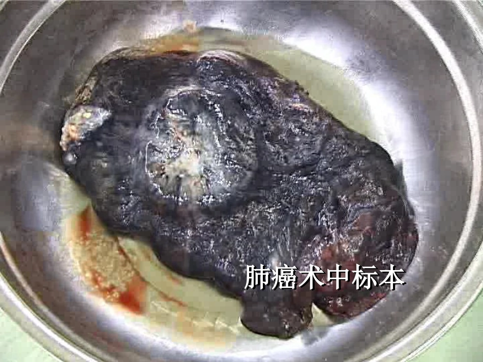 肿瘤科-肺癌-_第2页