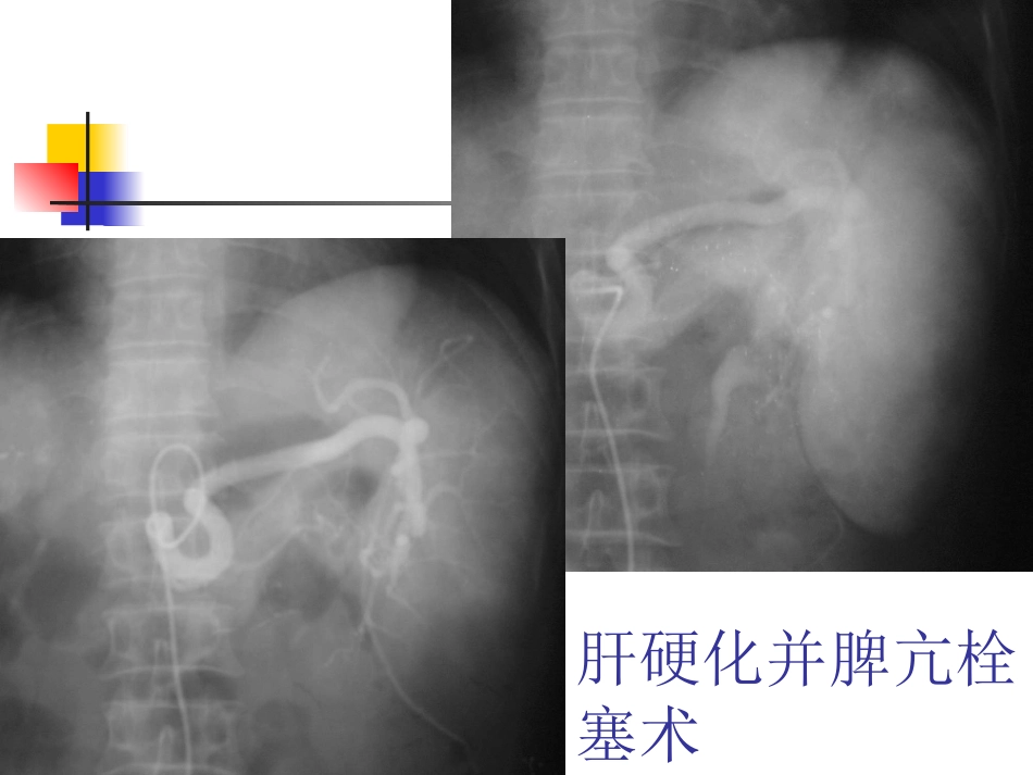 肝硬化门脉高压症的介入治疗_第15页