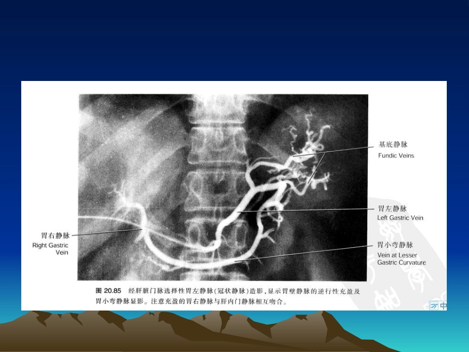 肝硬化食管胃底静脉曲张大出血介入治疗_第5页