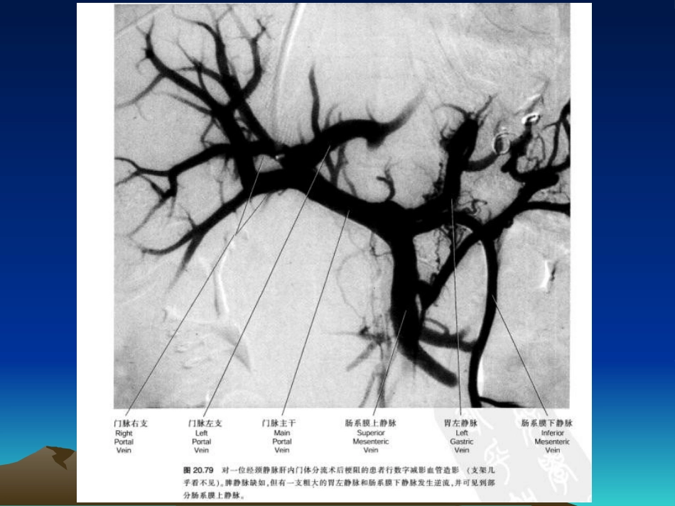 肝硬化食管胃底静脉曲张大出血介入治疗_第7页