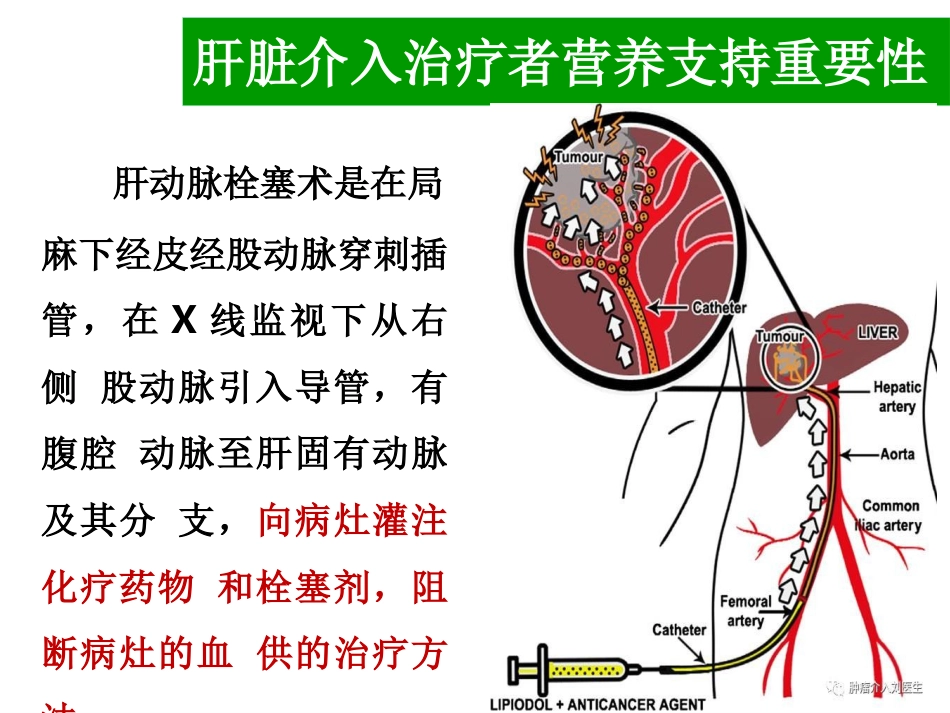 肝癌介入治疗者的营养支持_第4页