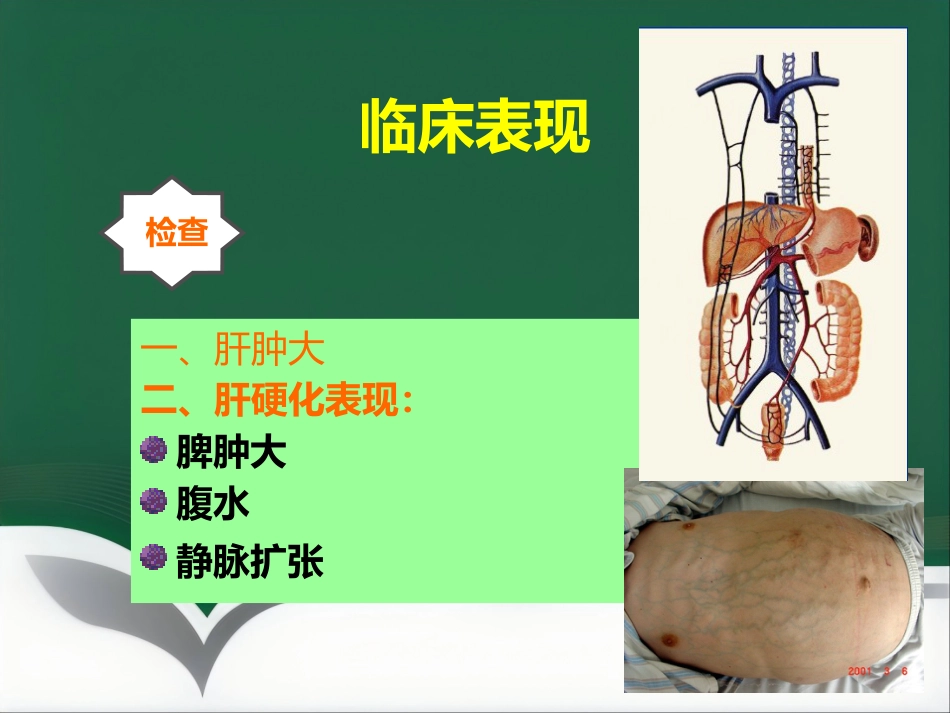 肝癌射频消融及介入治疗(1)_第13页