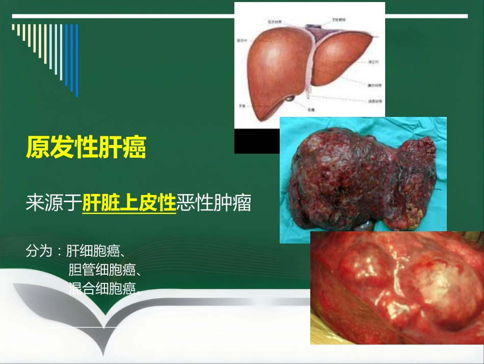 肝癌射频消融及介入治疗(1)_第4页