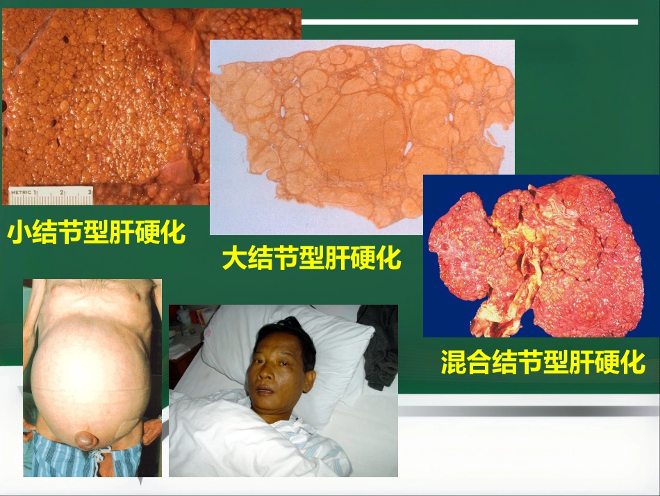 肝癌射频消融及介入治疗(1)_第8页