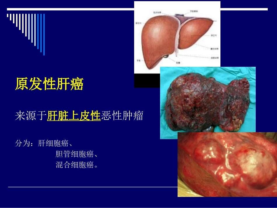 肝癌介入治疗(1)_第4页