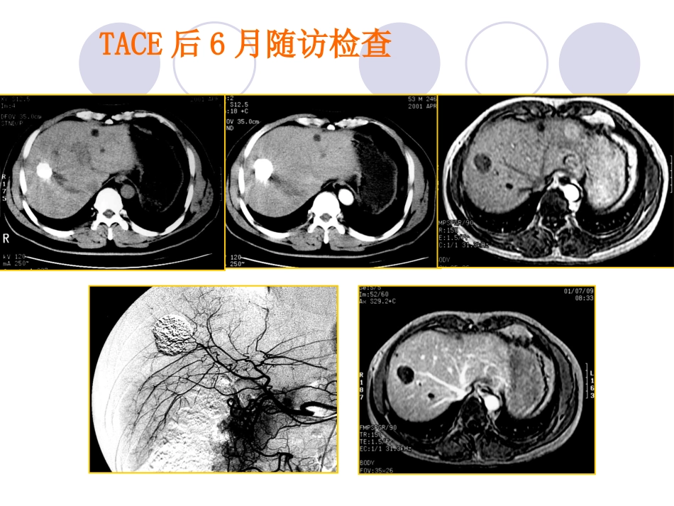 肝癌介入治疗 (3)_第15页
