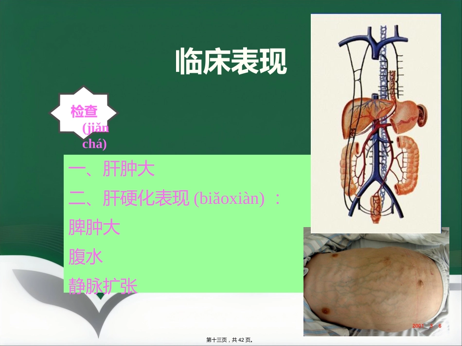 肝癌射频消融及介入治疗(共42张PPT)_第13页