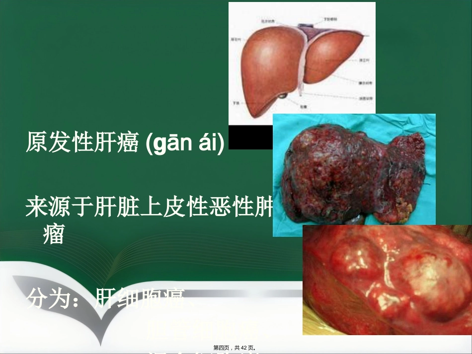 肝癌射频消融及介入治疗(共42张PPT)_第4页