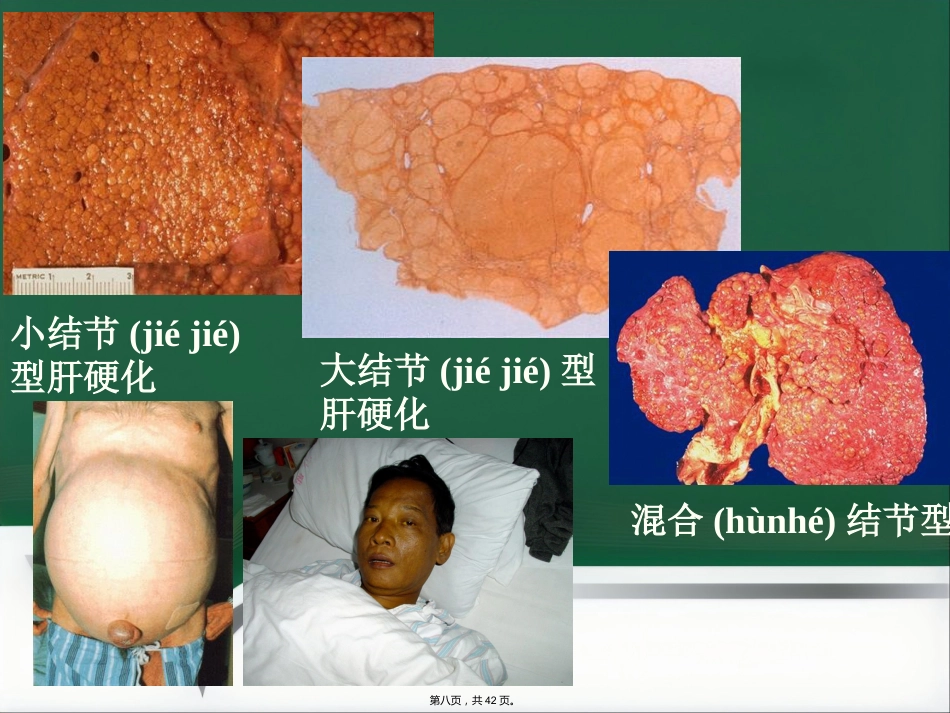 肝癌射频消融及介入治疗(共42张PPT)_第8页