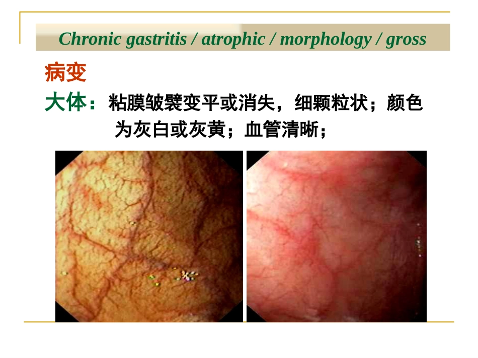 病理学—消化系统疾病(消化道,肝胆胰)_第12页