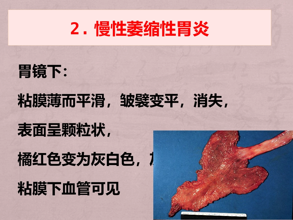病理学消化系统疾病_第11页