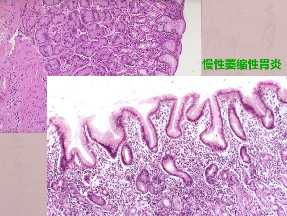 病理学消化系统疾病_第14页