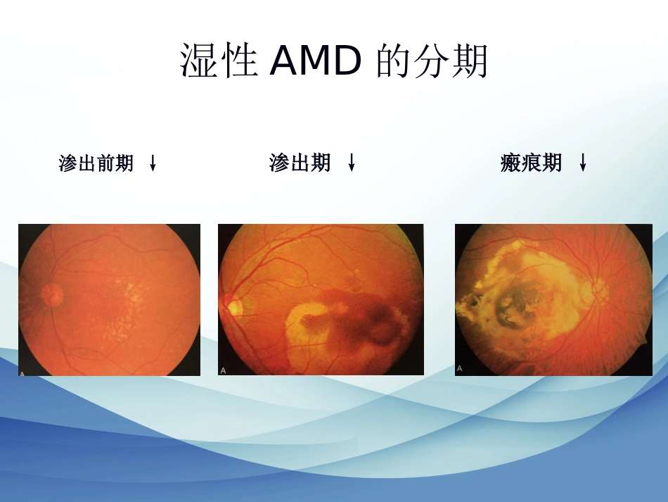 老年性黄斑变性标准版_第10页