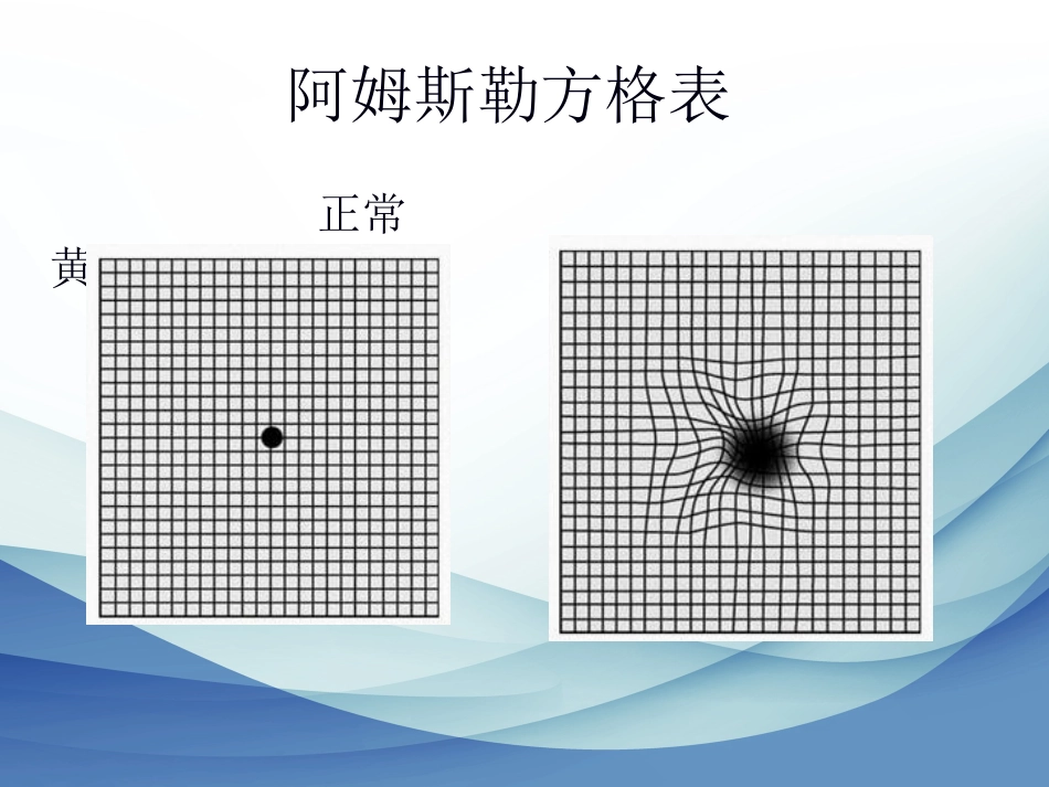 老年性黄斑变性标准版_第14页