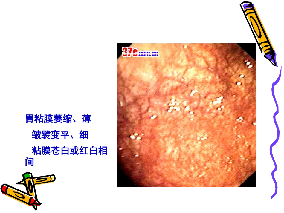 病理学--消化系统疾病_第10页