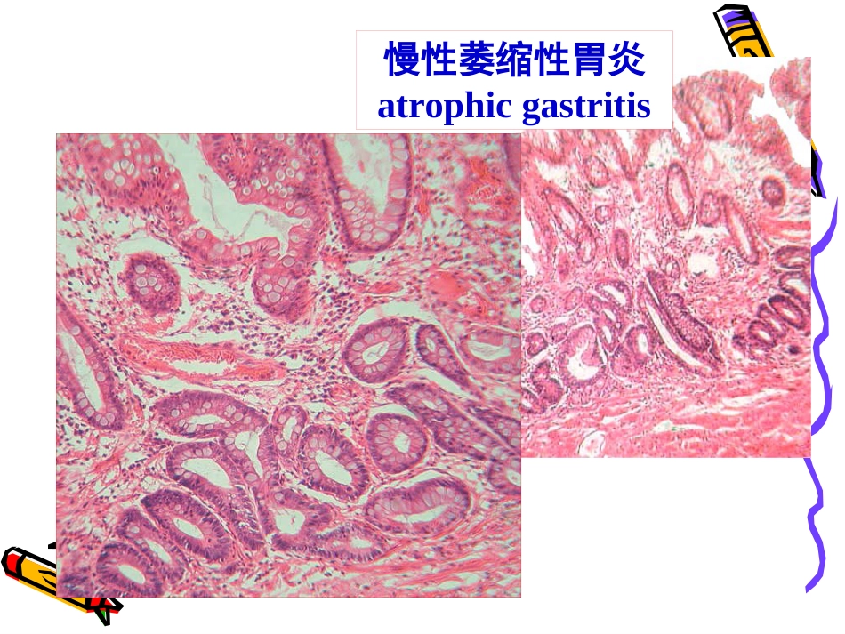 病理学--消化系统疾病_第13页