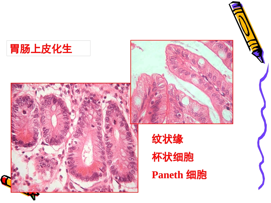 病理学--消化系统疾病_第14页