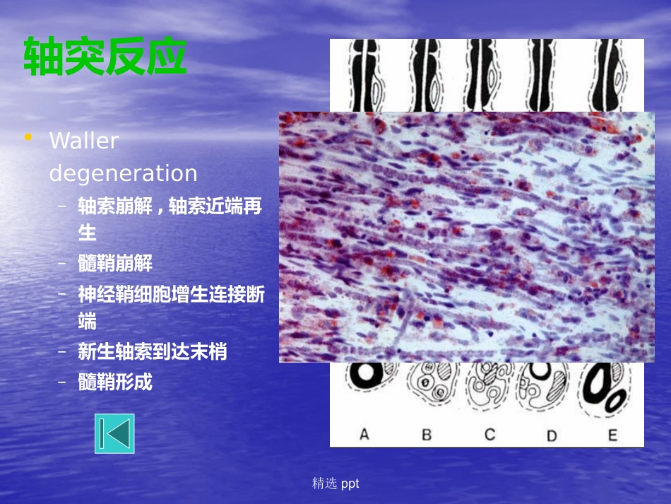 病理学神经系统疾病_第13页