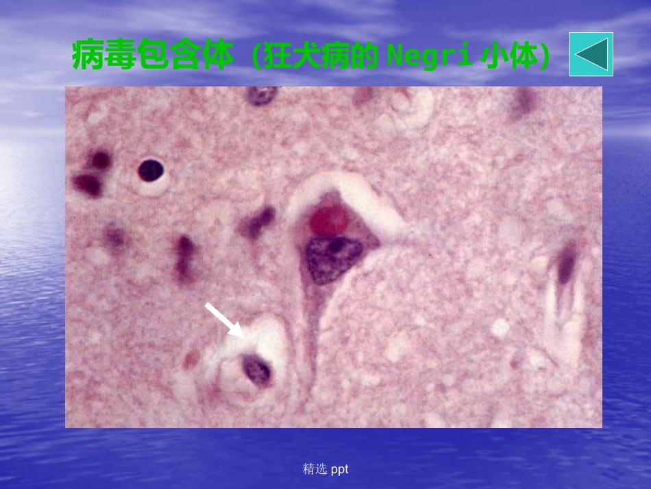 病理学神经系统疾病_第15页