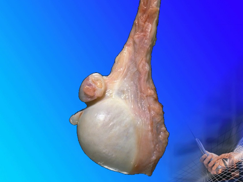 病理学-生殖系统和乳腺疾病_第3页
