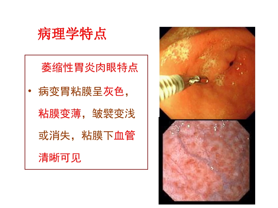 病理学胃炎胃溃疡_第8页