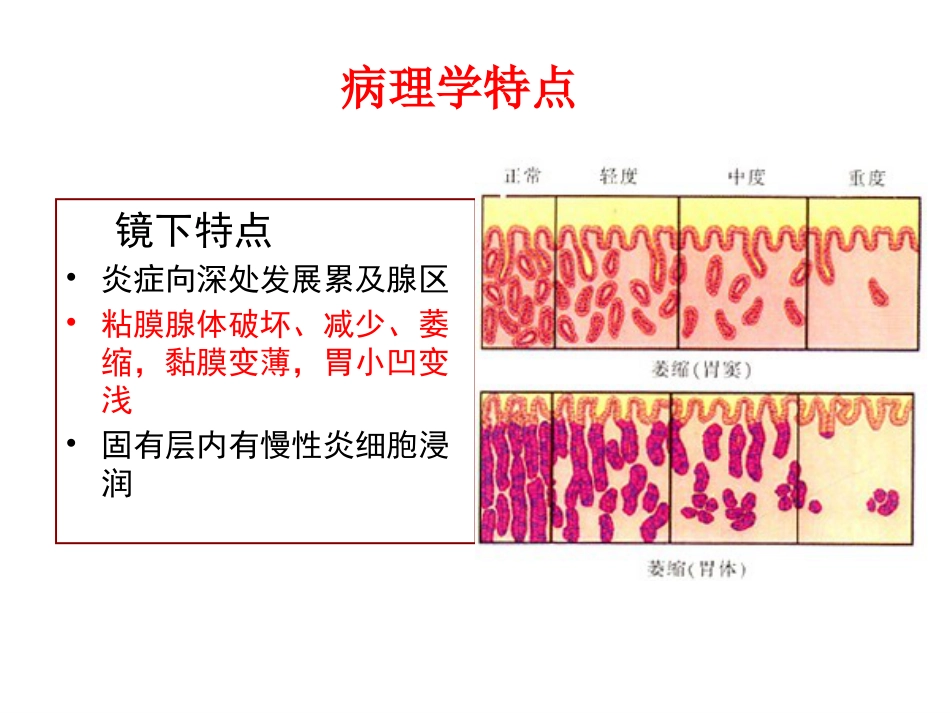 病理学胃炎胃溃疡_第9页
