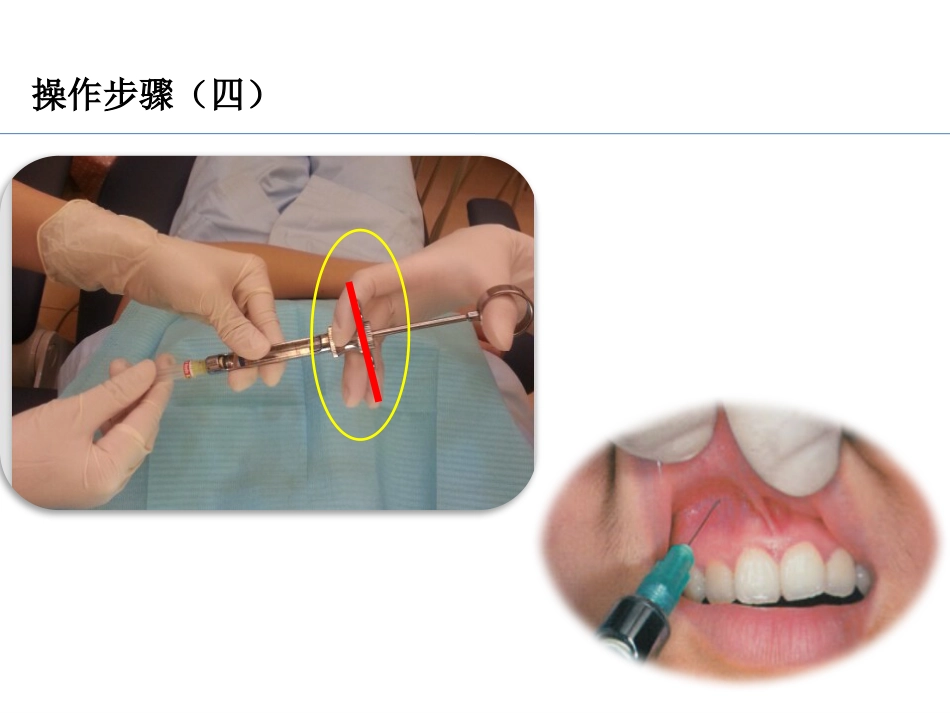 PZ-imp-TEK入四手操作配合_第7页