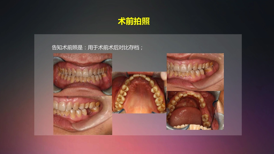 口腔培训009.种植牙手术配台准备和操作流程_第14页