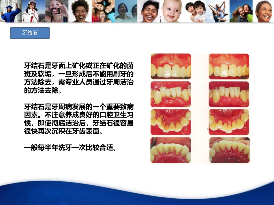 口腔培训020.牙周病_第3页