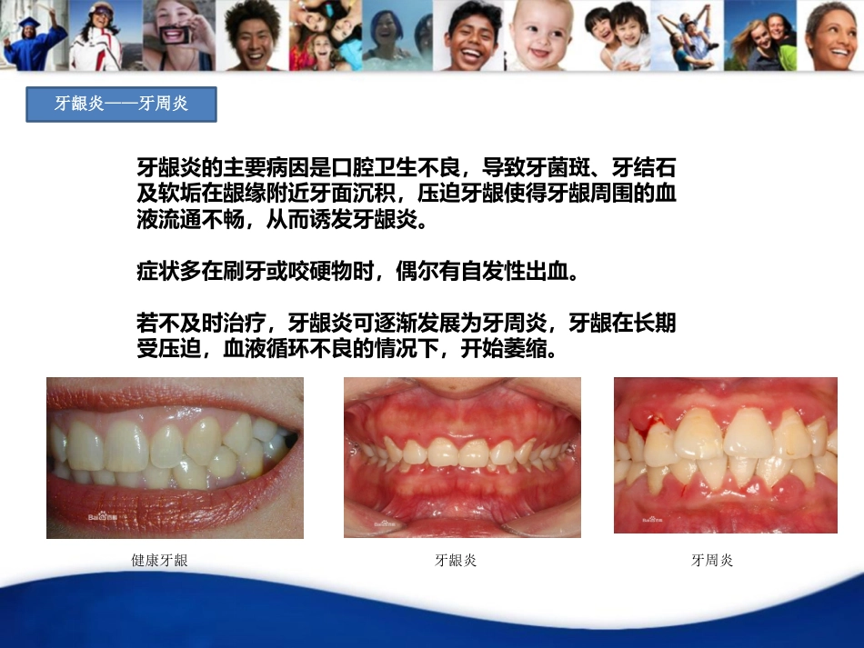 口腔培训020.牙周病_第4页