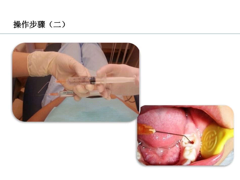 口腔培训036.RCF形成，四手操作_第11页