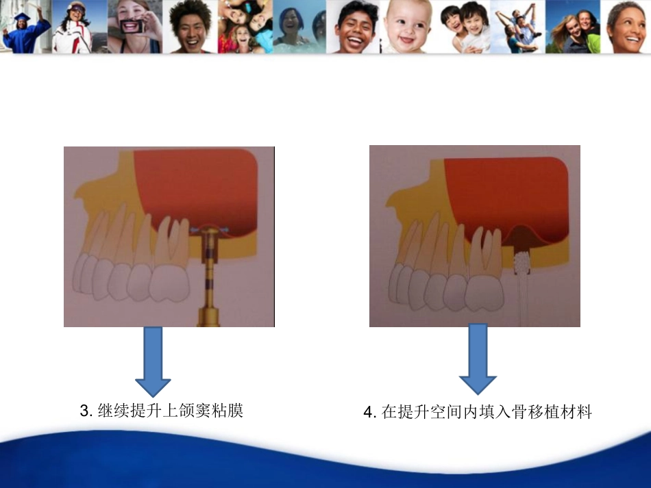 口腔培训040.上颌窦内提升手术_第10页