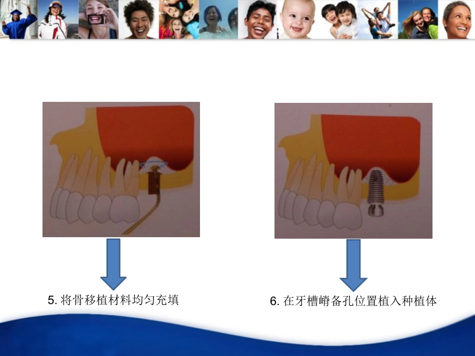 口腔培训040.上颌窦内提升手术_第11页