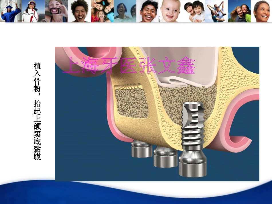 口腔培训041.上颌窦外提升手术_第10页