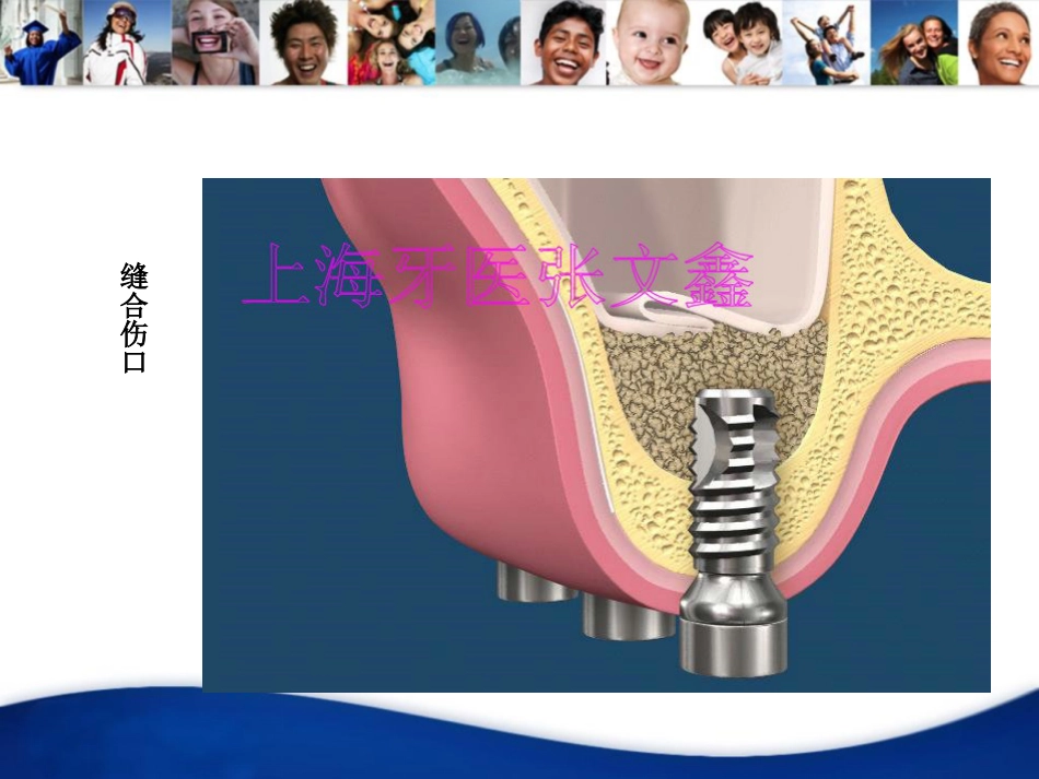 口腔培训041.上颌窦外提升手术_第12页