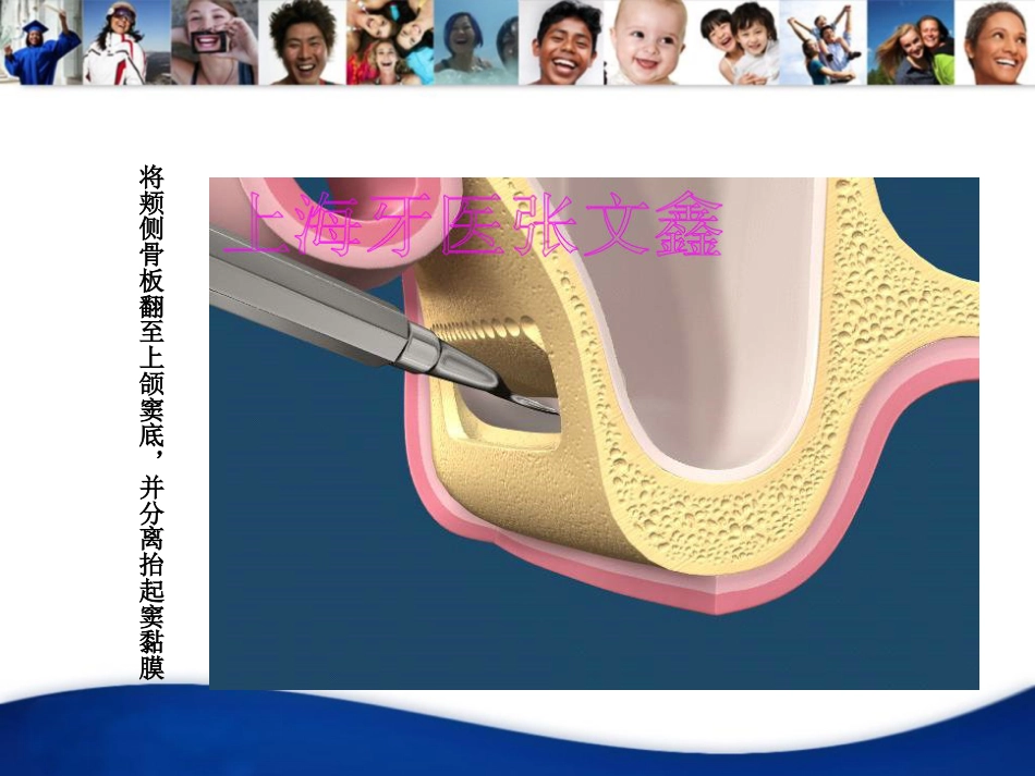 口腔培训041.上颌窦外提升手术_第7页