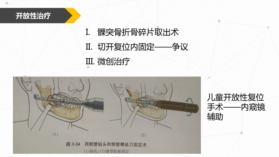 口腔培训047.儿童髁突骨折处理_第12页