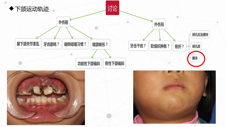 口腔培训047.儿童髁突骨折处理_第2页