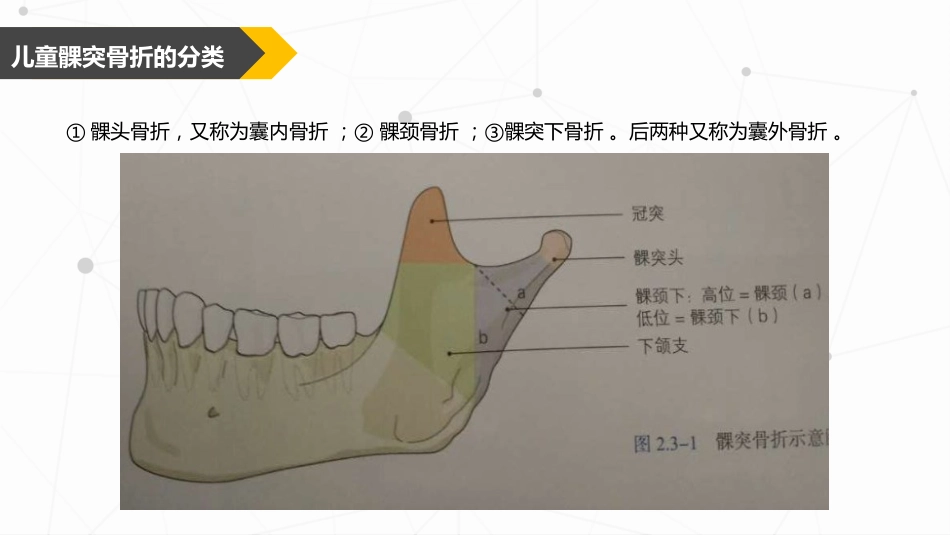 口腔培训047.儿童髁突骨折处理_第8页