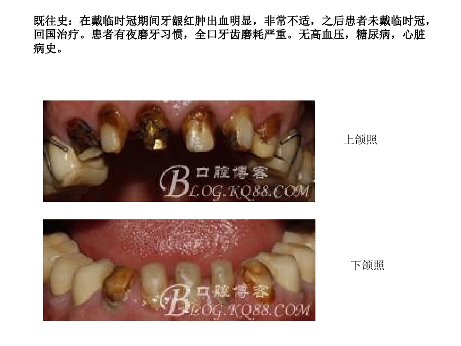 口腔培训051.口腔修复学中的咬合重建问题_第10页
