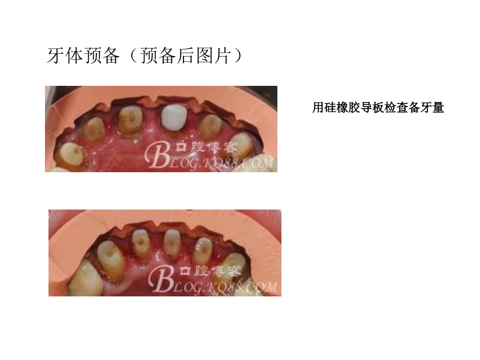 口腔培训051.口腔修复学中的咬合重建问题_第15页