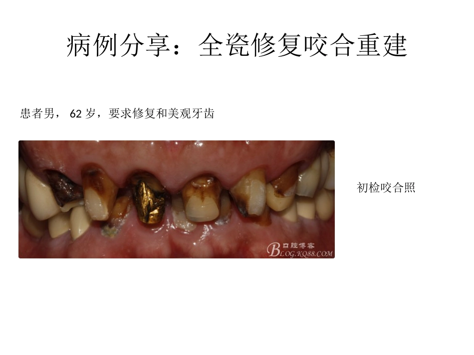 口腔培训051.口腔修复学中的咬合重建问题_第8页