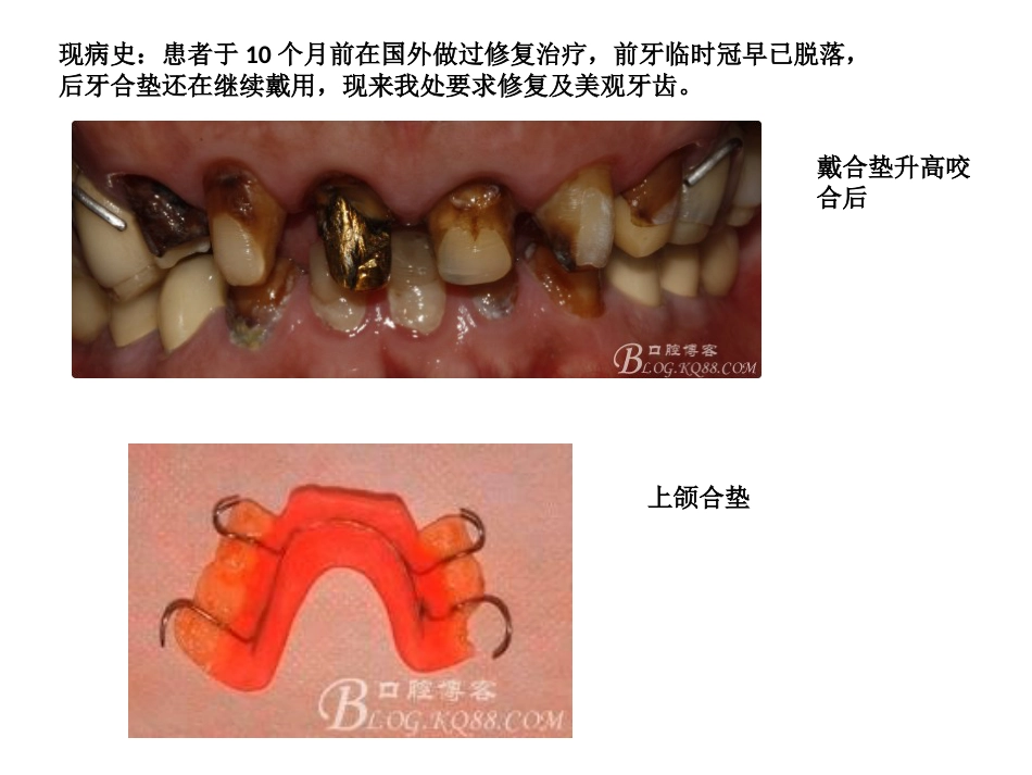 口腔培训051.口腔修复学中的咬合重建问题_第9页