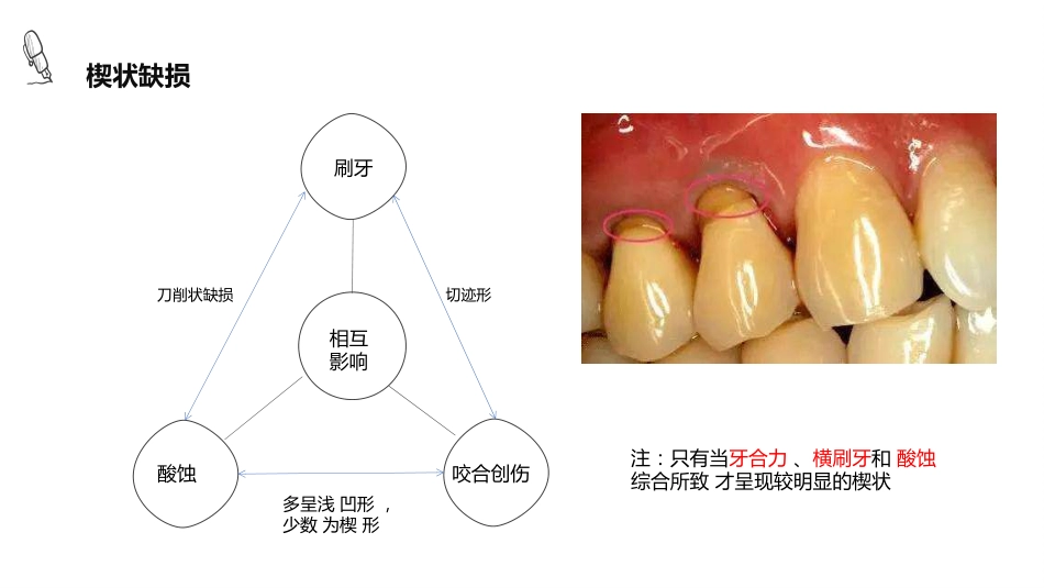 口腔培训081.楔状缺损_第4页
