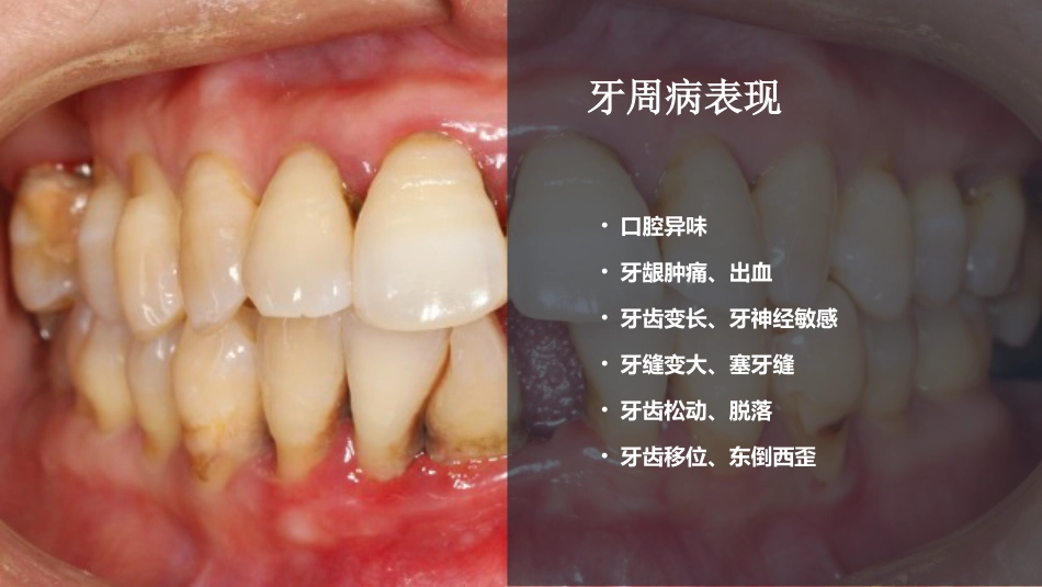 口腔培训084.洁牙沟通2_第5页